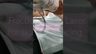 Fractional Co2 laser Treatment [upl. by Elidad]