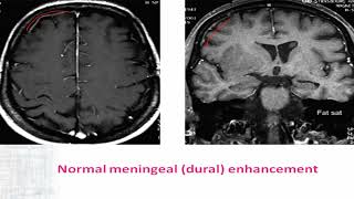 04 IBIC Supratentorial Extraaxial lesions Part02 [upl. by Llessur]