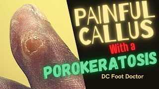 Painful Callus with a Porokeratosis [upl. by Ohara480]