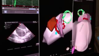 Lowradiation Ablations [upl. by Akit]