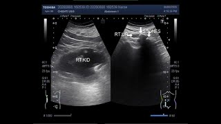 Ultrasound Video showing Two large ureteric stones [upl. by Seafowl]