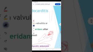 Infective endocarditis [upl. by Dur]