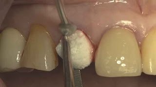 Immediate implantation with flapless simple grafting on upper anterior area [upl. by Perren]