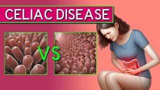 Celiac Disease The Silent Threat in Your Gut – Symptoms amp Treatment Explained [upl. by Meda573]