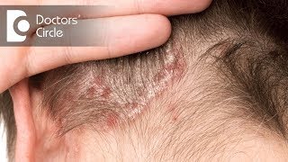 Treatment options for Scalp Psoriasis  Dr Rashmi Ravindra [upl. by Efthim]