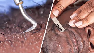 Ingrown Hair Treatment [upl. by Hnil]