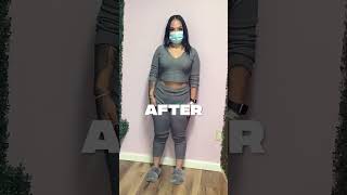 41 Lbs In 6 Month After Her Orbera Gastric Balloon Procedure 🔥❗️ nonsurgicalweightloss [upl. by Ravid]