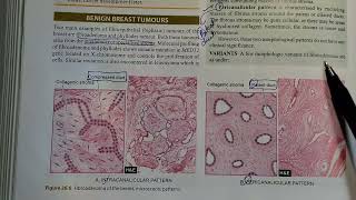 Fibroadenoma fully Explained Pathology ⚕️ [upl. by Travax713]