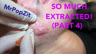 So much extracted Severe acne before and after Session 2 Comedones for days [upl. by Dina448]