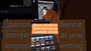 sténose carotidienne serrée traitée par une angioplastie stenting [upl. by Neyud991]