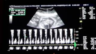 Baby 12 Week Ultrasound amp Heartbeat [upl. by Caralie]