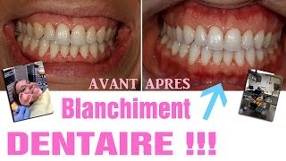 Blanchiment dentaire  AVANTAPRES Revue 25 [upl. by Anaer]