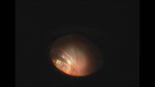 Vitrectomy and Perfluoron for Retinal Detachment with Giant Retinal Tear [upl. by Morocco154]