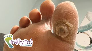 DEEP SATISFYING CALLUS TREATMENT [upl. by Neumark999]