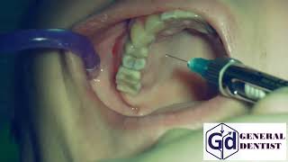 Infiltration anesthesia for treatment 15 [upl. by Ilzel175]