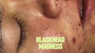 Most Satisfying Blackhead amp Acne Removal Deep Face Cleansing Compilation 67 [upl. by Sosthenna334]