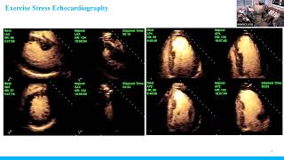 Multimodality Imaging Hypertrophic Cardiomyopathy [upl. by Erej]