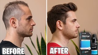 उड़े हुवे बाल को फिर से उगाए  minoxidil hair regrowth results  mintop minoxidil  derma roller [upl. by Ammann]