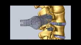 Minimally Invasive Transforaminal Lumbar Interbody Fusion Procedure [upl. by Ysnat820]