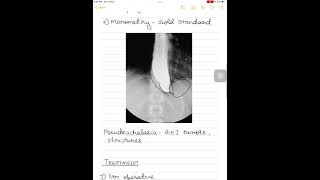 Achalasia cardia surgeryneetpg [upl. by Erialcyram]