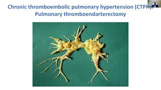 Does Rudolf Virchow hold all the answers for Venous ThromboEmbolism Assessments [upl. by Stace]