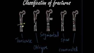 Classifying and presenting Fractures  Orthopaedics for Medical Students  Finals [upl. by Simon]