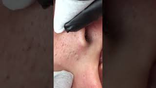 Ear blackhead removal [upl. by Nyladnek]