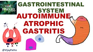 AUTOIMMUNE ATROPHIC GASTRITIS Pathogenesis clinical features morphology amp prognosis [upl. by Dannica]