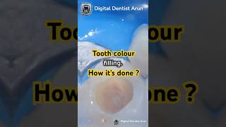 From Cavity to Perfect Smile How a Composite Filling Restores Your Tooth [upl. by Anneiv809]