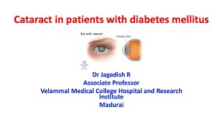 Cataract in diabetes [upl. by Adyaj]