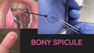 Bone Spicule  Minor Surgery [upl. by Ailaham]