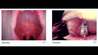 Koplik spots measles rubeola virus [upl. by Thaddus]