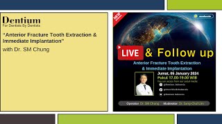 Live Surgery quotAnterior Fracture Tooth Extraction amp Immediate Implantationquot [upl. by Nednal725]