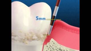 Perio Chip for Periodontal Disease Treatment  Lake Merritt Dental Oakland CA [upl. by Ecirpac]