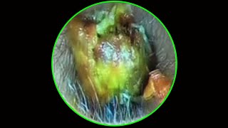 Tympanic membrane perforation and postoperative debridement for cholesteatoma EP 59 [upl. by Kipper]