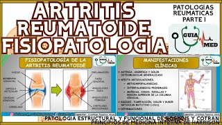 ARTRITIS REUMATOIDE FISIOPATOLOGÍA  GuiaMed [upl. by Kobe359]