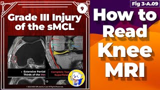 Fig 3A09 Grade III Injury of the sMCL and Medial Patellofemoral Ligament Injuries [upl. by Ennairak]