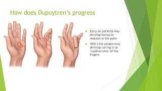 Dupuytrens Contracture Treatment  Everything You Need to Know [upl. by Morganstein493]