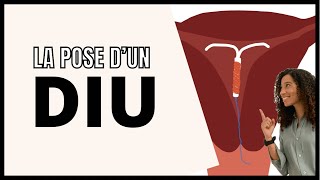 Comment se passe la pose d’un stérilet DIU  Dispositif Intra Utérin [upl. by Rosemonde]