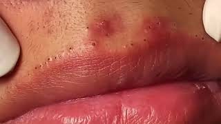 Most Painful Blackhead Removal on Lips [upl. by Nalyd724]