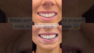 Composite bonding by Dr Stephen 😍 ruhdental newsmile veneers [upl. by Takeshi]