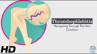 Thrombophlebitis 101 Navigating the Challenges of Vein Conditions [upl. by Sillyhp418]