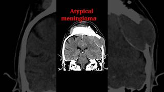 Meningioma shorts radiology education radiologyjunction [upl. by Cutty]