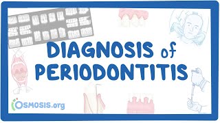 Diagnosis of Periodontitis [upl. by Oicangi]