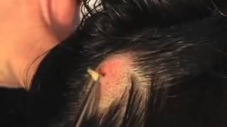 The Botfly in the Head [upl. by Nim715]