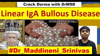 Linear IgA Bullous Disease  Bullous Disease of Childhood  LABD  Crown Cluster of JEWEL  DrMSD [upl. by Yrdnal]