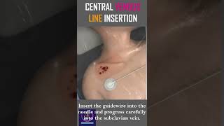 Central Venous Line Insertion  Step By Step Procedure  shorts [upl. by Enyehc]