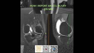 ACL Injury MRI Key Insights for Effective Treatment  Dr Gaurav Vashisht radiologist radiology [upl. by Alian782]