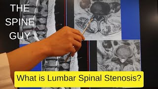 Part 1  What is Lumbar Spinal Stenosis [upl. by Esor220]