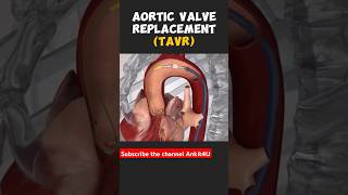 Angioplasty Procedure ytshorts angioplasty angiography shortsfeed [upl. by Swarts99]